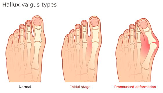 🦶 ¿Qué son los juanetes y cómo prevenirlos desde la infancia?